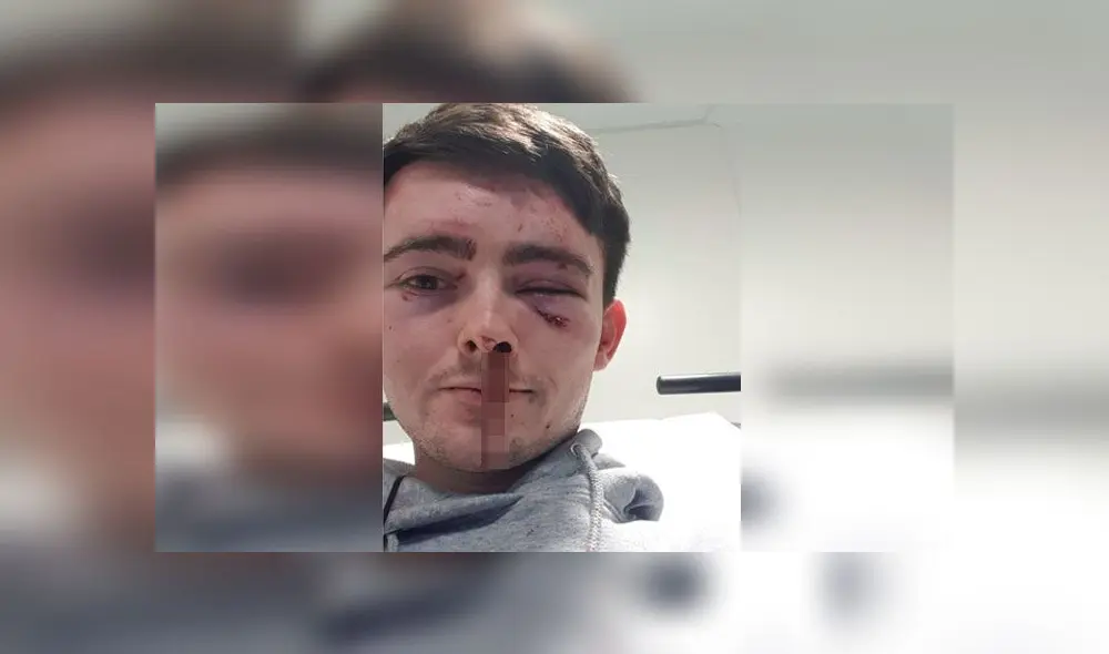 Hombre queda con lesiones en los ojos tras recibir brutal agresión de ladrones [FOTOS]