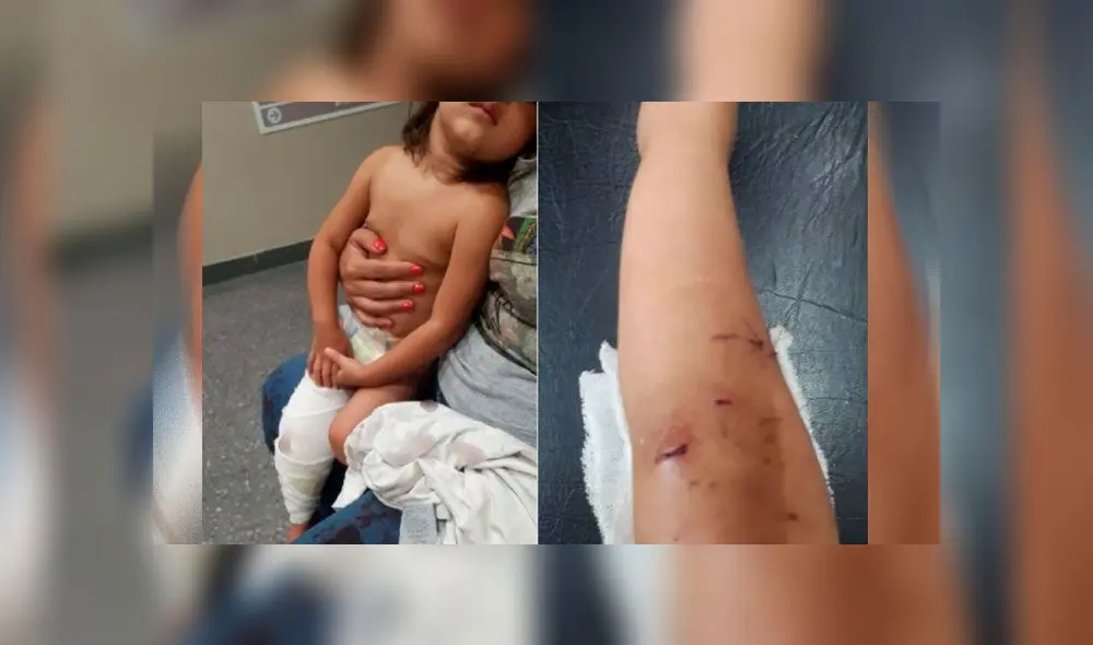 Niña de dos años sufre salvaje ataque de perro pitbull y recibe 40 puntos en su pierna [VIDEO]