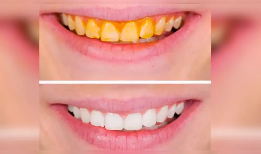 YouTube: conoce cómo blanquear tus dientes en tan solo 5 minutos [VIDEO] 