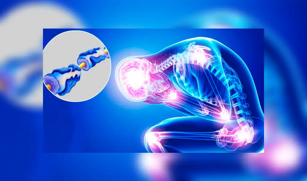 Síndrome de Guillain-Barré: ¿Cuál es el precio del tratamiento de inmunoglobulina?