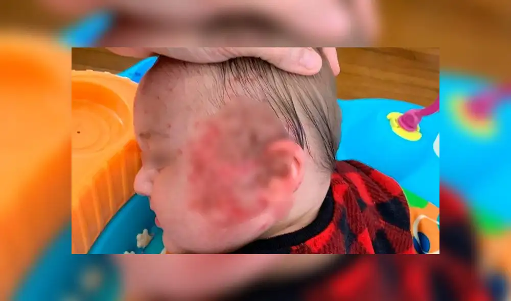 Mujer muestra terrible enfermedad que sufrió su bebé tras recibir un beso [FOTOS]