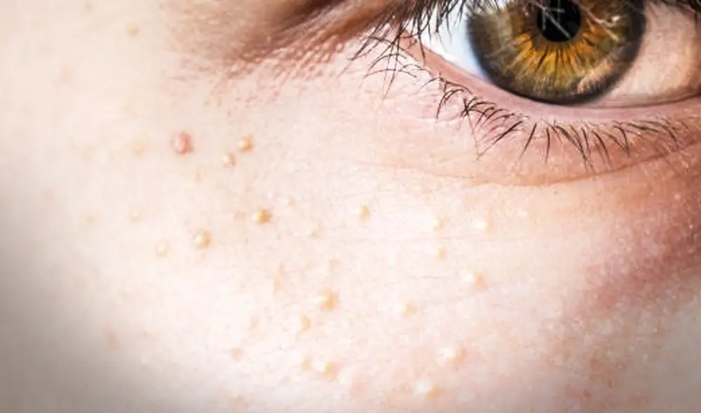 Puntos blancos en la piel. millium sebáceo - quistes de millium. Foto: Archivo LR