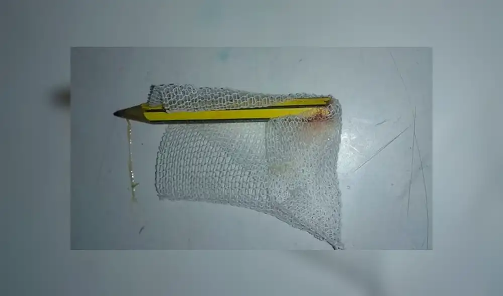 La madre halló el lápiz cuando faltaba poco para que su hija fuese operada. Fuente: Telefé. La madre halló el lápiz cuando faltaba poco para que su hija fuese operada. Fuente: Telefé.