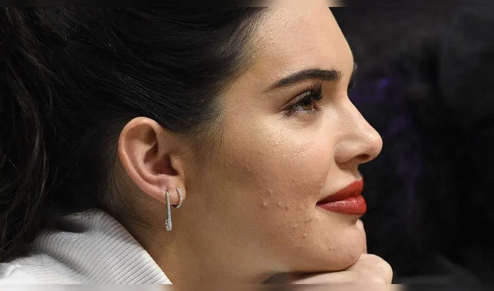 Kendall Jenner sufre por no poder ocultar las cicatrices del acné en su cara