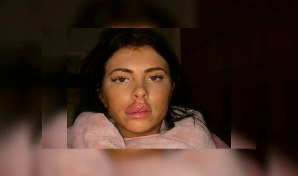 Se operó los labios, reventó y casi queda ciega por la pus que saltó a su ojo [FOTOS]