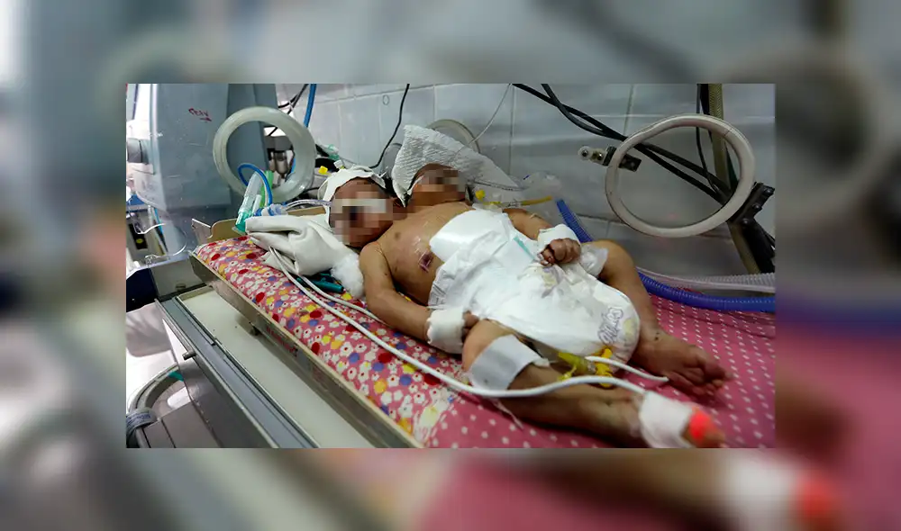 Bebés siameses mueren en Yemen al no recibir tratamiento [VIDEO]