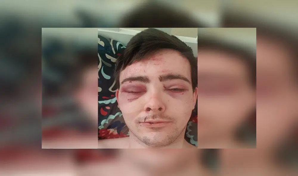 Hombre queda con lesiones en los ojos tras recibir brutal agresión de ladrones [FOTOS]