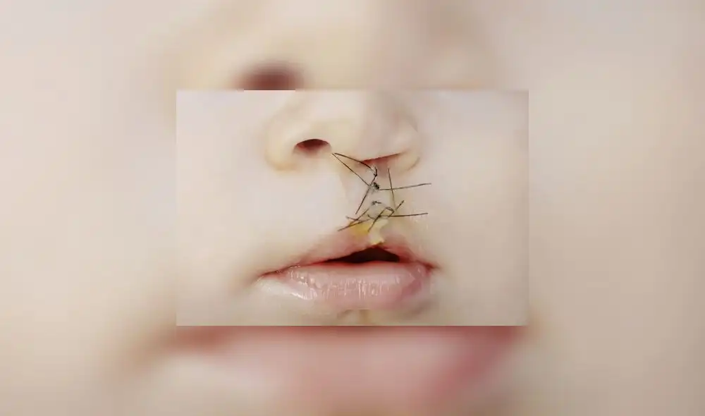 Labio leporino: causas, factores de riesgo y tratamiento