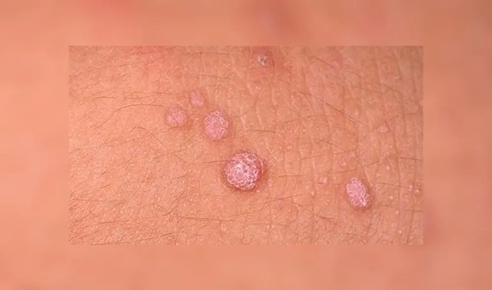 Cada cinco horas fallece una mujer por cáncer de cuello uterino en el Perú