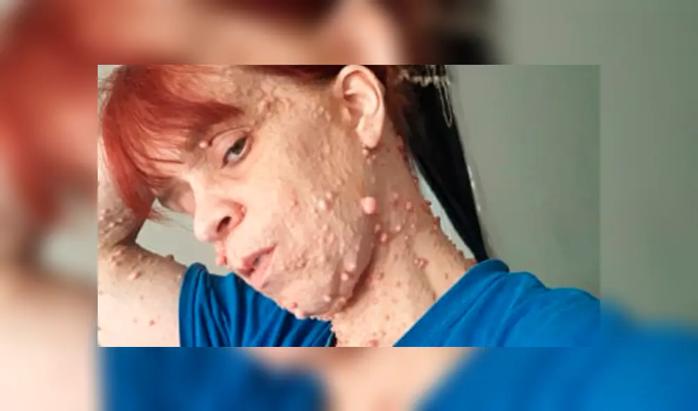 Mujer cubierta de más de 2.000 tumores revela que es abusada por extraños en la calle [FOTOS]