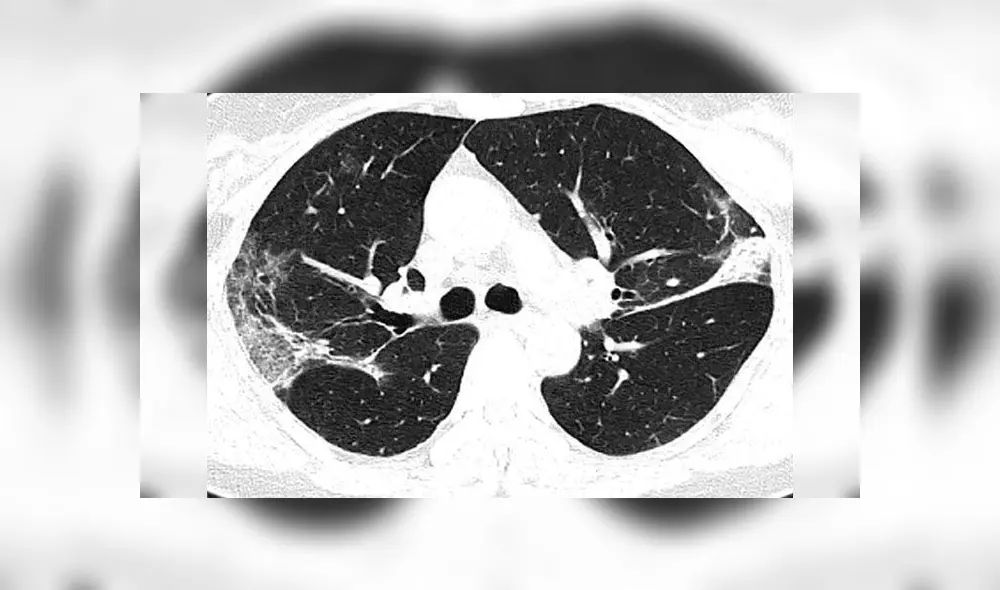 Tomografías muestran el daño que causa el coronavirus en los pulmones [FOTOS]