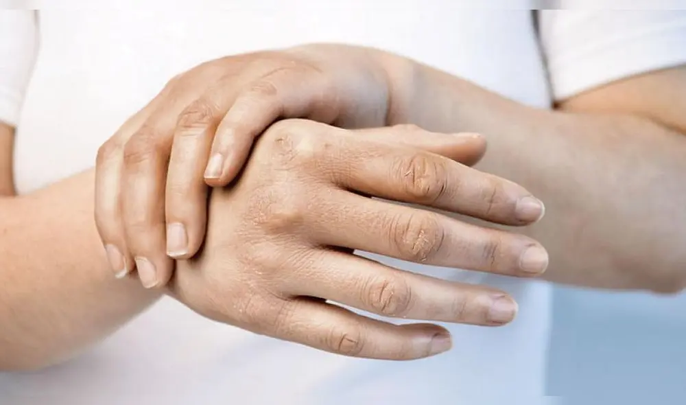 La esclerodermia afecta en su mayoría a mujeres a partir de los 30 años. (Foto: TV Notas)