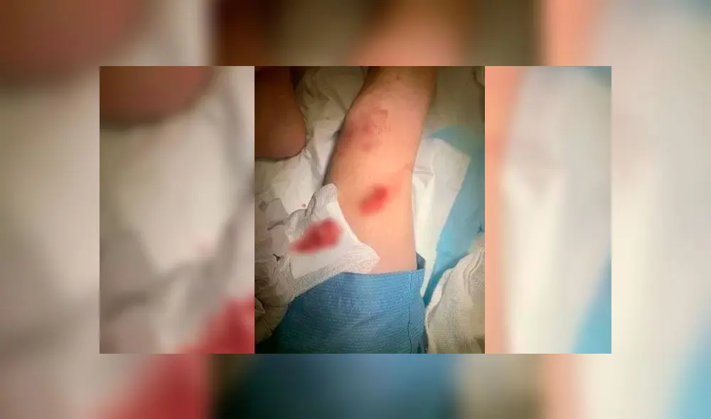 Ataque de serpiente Ataque de serpiente