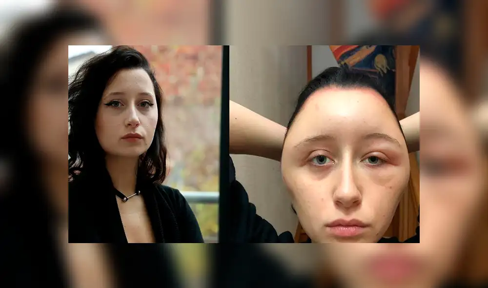 Facebook: chica acaba con la cara hinchada, porque se pintó el pelo y era alérgica al tinte [VIDEO]