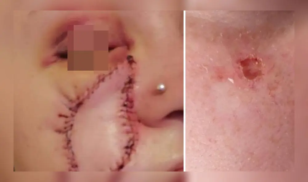 Louise Thorell se sometió a una cirugía para eliminar la cicatriz que le dejó el cáncer de piel. Foto: Difusión.