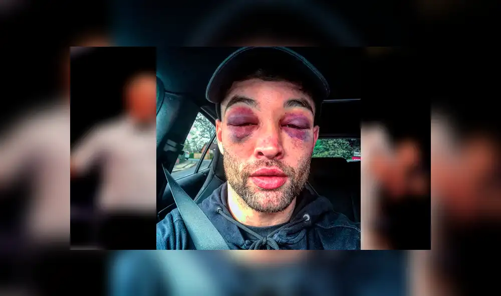 Boxeador queda irreconocible tras brutal paliza que recibió durante un combate [FOTOS]