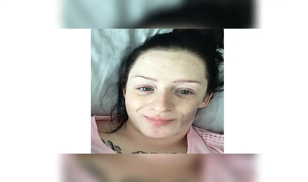 Rara enfermedad obligó a mujer a reconstruirse el rostro con grasa de su estómago 