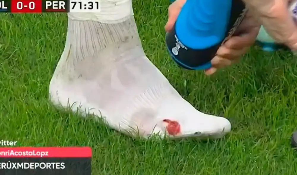 ¡Suenan las alarmas! Santamaría sufrió sangrado en el pie tras duro golpe de Yerry Mina [VIDEO] 