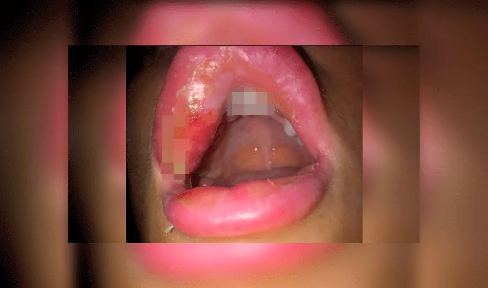 Se operó los labios, reventó y casi queda ciega por la pus que saltó a su ojo [FOTOS]