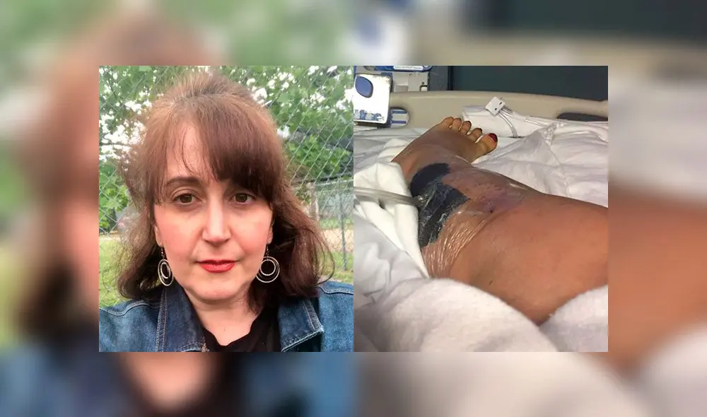 Mujer acaba con un agujero en la pierna tras someterse a una liposucción [FOTOS]