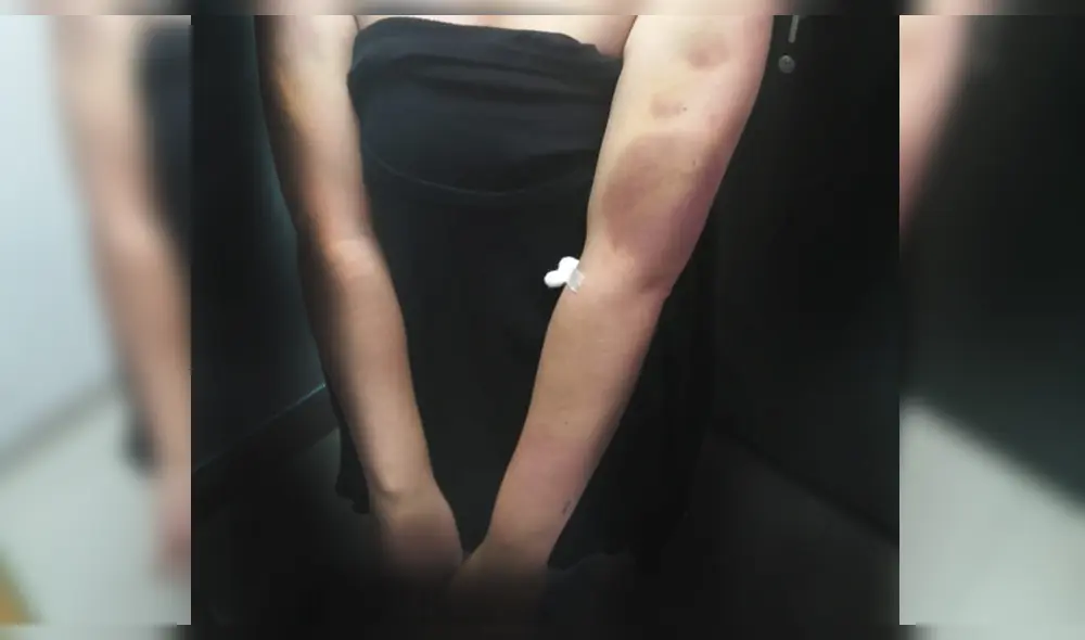 La víctima mostró parte de lesiones ocasionadas por su pareja. La víctima mostró parte de lesiones ocasionadas por su pareja.