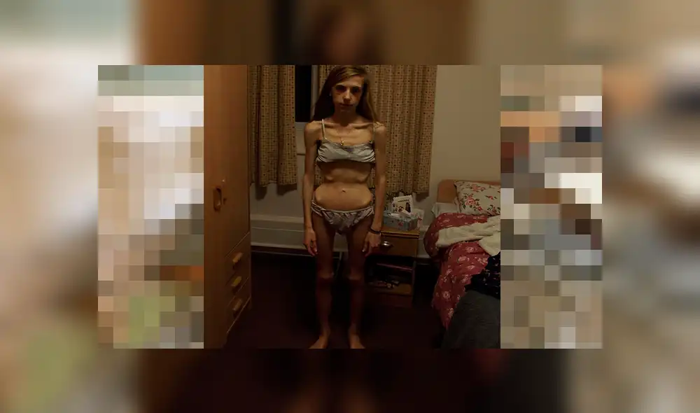 Joven salva de morir de anorexia gracias a una carta de su padre [FOTOS] 