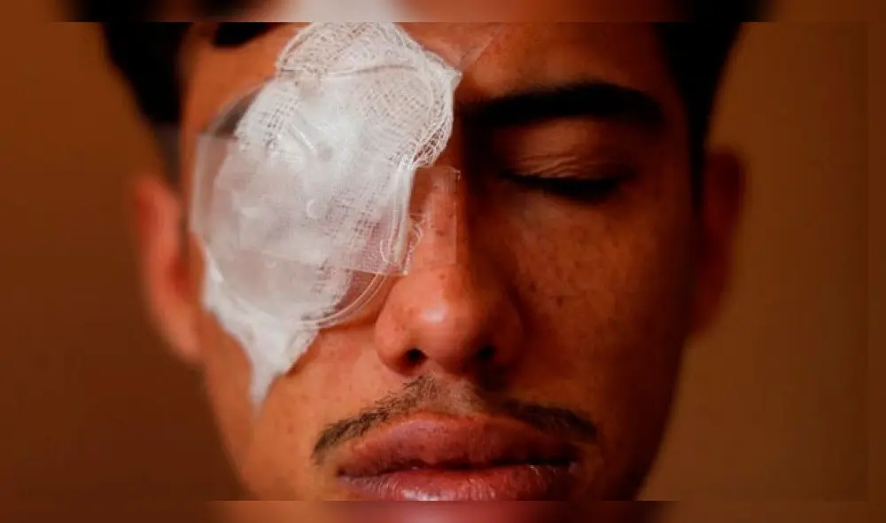 Víctimas de trauma ocular exigen a gobierno de Piñera una reparación efectiva Víctimas de trauma ocular exigen a gobierno de Piñera una reparación efectiva