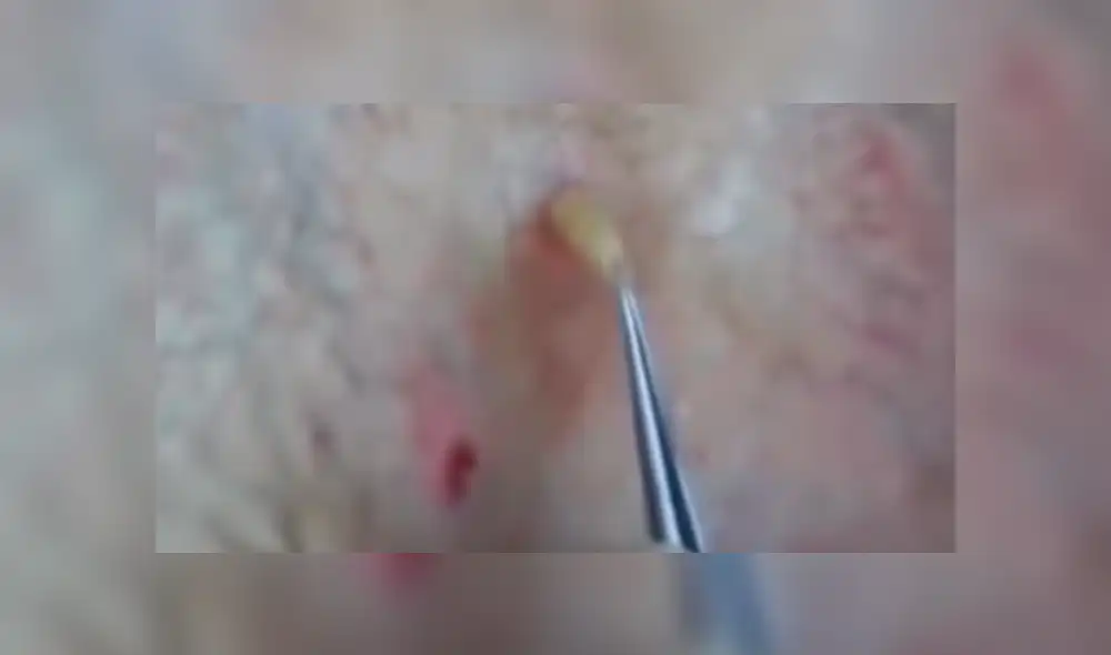 Facebook viral: misteriosas criaturas vivían dentro de la espalda de un joven sin que él lo sepa [VIDEO]