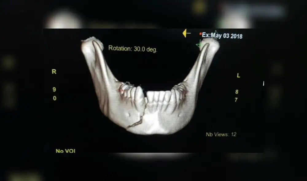 Reconstruyen mandíbula a menor víctima de violencia escolar [FOTOS]