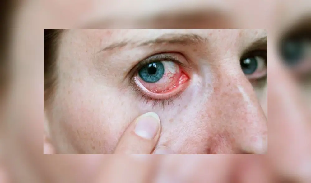Dianne Travers Gustafson jamás imaginó que se convertiría en la segunda persona infectada con gusanos parasitarios en sus ojos tras toparse con un enjambre de moscas.