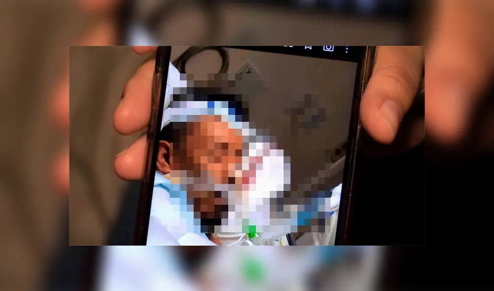 amputación amputación