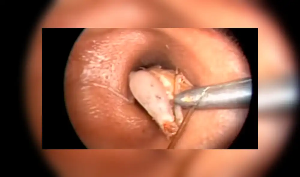 YouTube viral: médico encuentra 'misteriosa criatura' dentro de oído que genera terror [VIDEO]