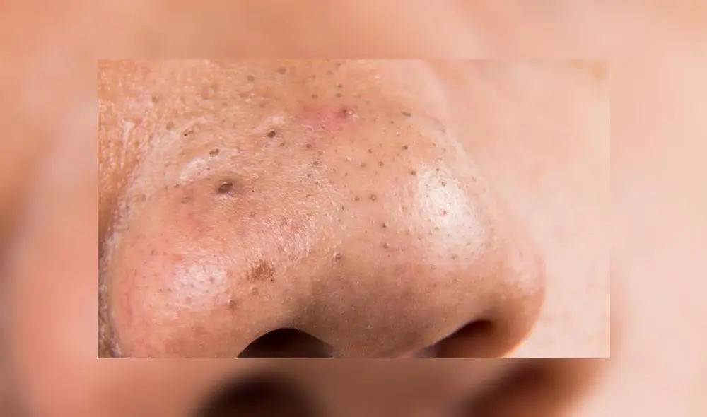 puntos negros nariz puntos negros nariz