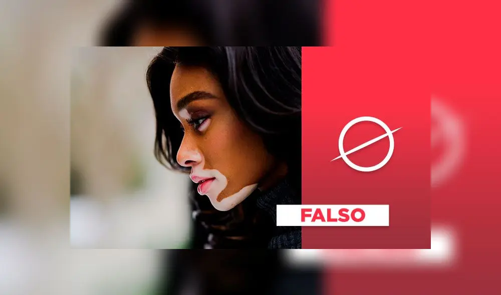 El vitiligo no es contagioso. El vitiligo no es contagioso.