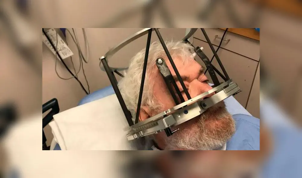 Frank Plummer fue sometido a una estimulación cerebral profunda para superar su problema de alcoholismo. Foto: Difusión Frank Plummer fue sometido a una estimulación cerebral profunda para superar su problema de alcoholismo. Foto: Difusión