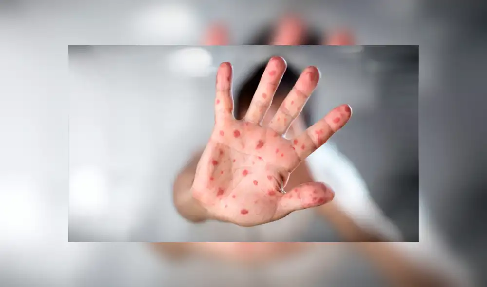 El sarampión es uno de los virus humanos más contagiosos del mundo, pero se puede prevenir casi por completo mediante la vacunación.  Foto: La República