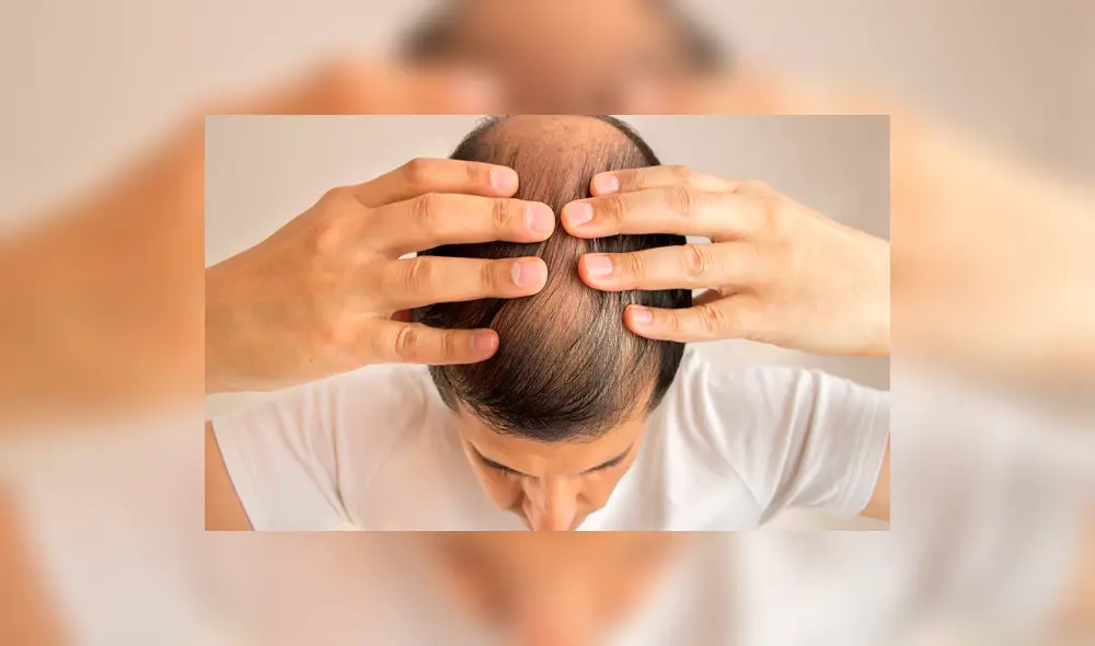 Los jueces dijeron que sufrir de calvicie puede ser emocionalmente devastador para un hombre. Foto: EFE Los jueces dijeron que sufrir de calvicie puede ser emocionalmente devastador para un hombre. Foto: EFE