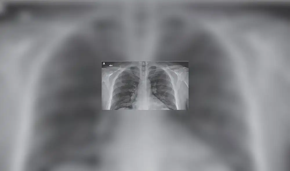 Tomografía de pulmones. Foto: Rehab