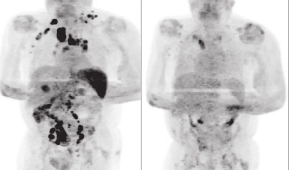 Antes y después. Imágenes tomográficas del paciente que se curó de un linfoma de Hodgkin tras contraer COVID-19. Foto: Challenor et al Antes y después. Imágenes tomográficas del paciente que se curó de un linfoma de Hodgkin tras contraer COVID-19. Foto: Challenor et al