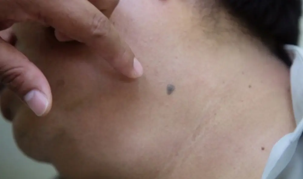 El color, tamaño y forma del lunar son características que nos pueden ayudar a reconocer a un nevo displásico. Foto: Minsa El color, tamaño y forma del lunar son características que nos pueden ayudar a reconocer a un nevo displásico. Foto: Minsa