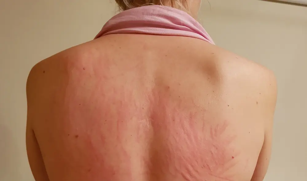 Las erupciones de urticaria normalmente se presentan en estadíos tempranos de la COVID-19, aunque se pueden extender por semanas. Foto: Covidskinsigns Las erupciones de urticaria normalmente se presentan en estadíos tempranos de la COVID-19, aunque se pueden extender por semanas. Foto: Covidskinsigns