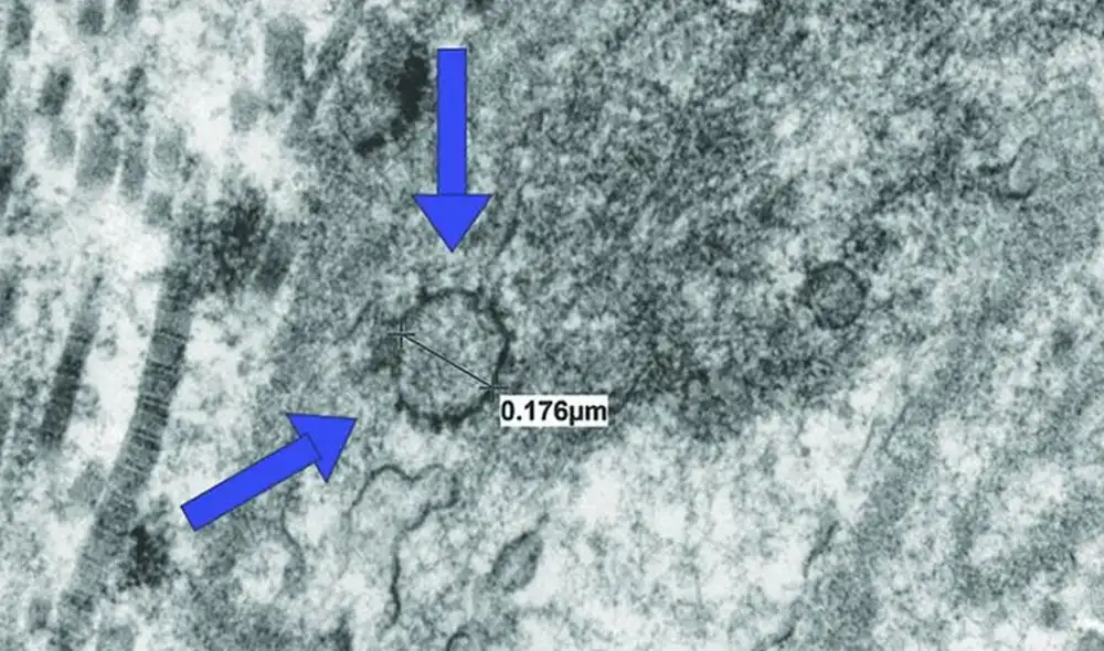 Partícula de coronavirus hallada en el tejido del pene de un recuperado de COVID-19. Foto: Ranjith Ramasamy