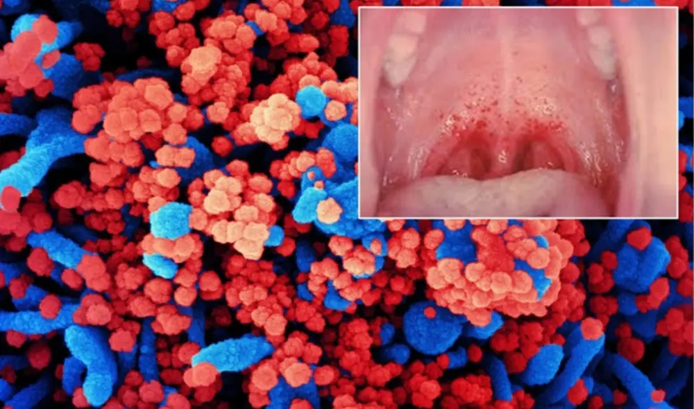 El coronavirus también puede causar erupciones dentro de la boca. Foto: difusión