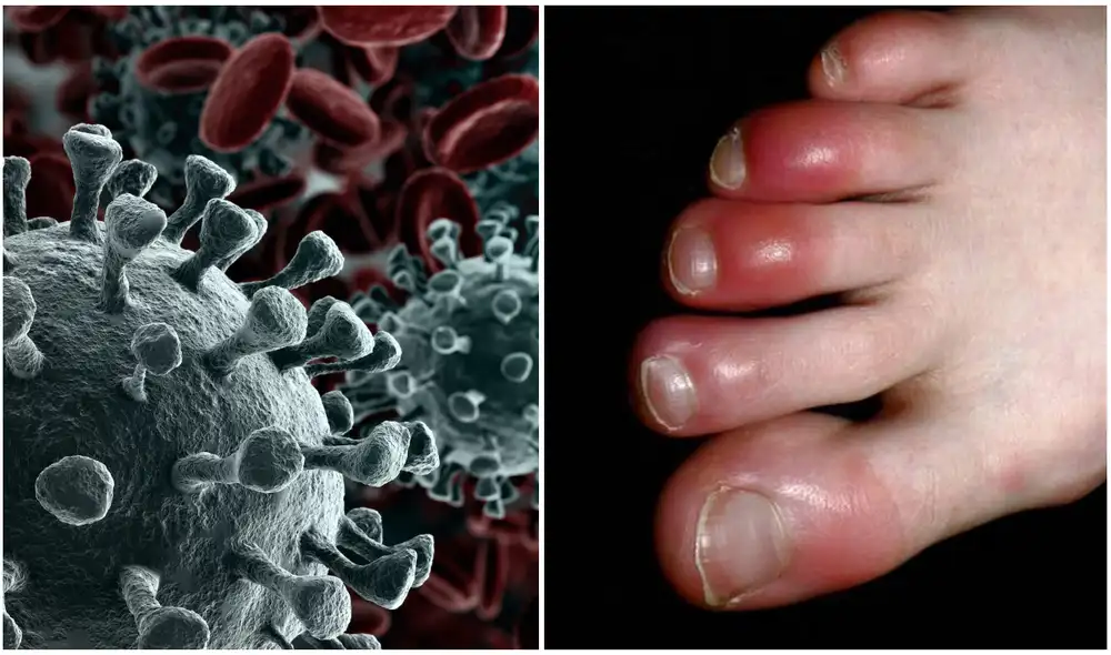 El conjunto de síntomas se suele manifestar a través de lesiones rojas o moradas en los pies, manos y dedos, tanto en el centro como en sus lados.  Foto: composición