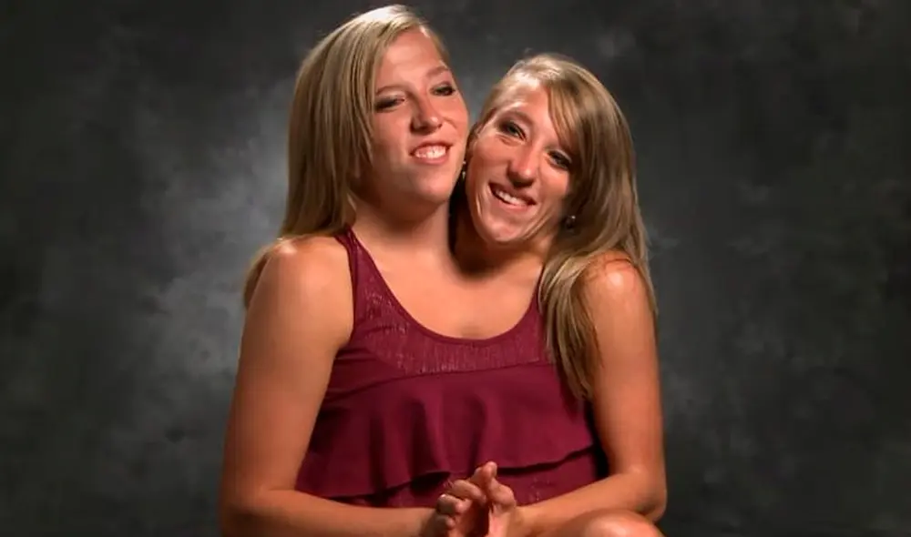 Las gemelas Hensel llegaron al mundo con una condición congénita particular: siamesas bicéfalas. Foto: Instagram Las gemelas Hensel llegaron al mundo con una condición congénita particular: siamesas bicéfalas. Foto: Instagram