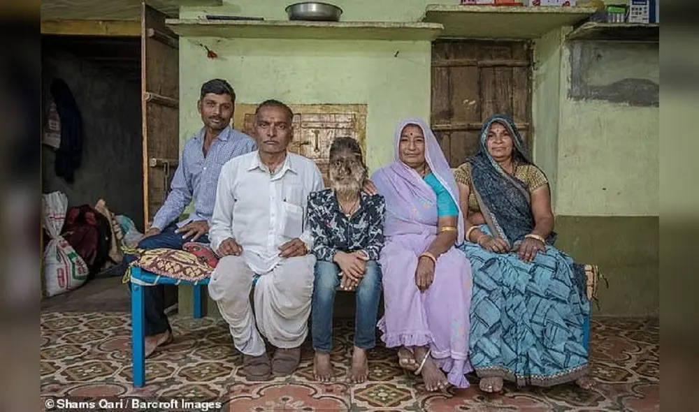 Lalit Patidar. Joven de la India padece el síndrome del "hombre lobo". Foto: Barcroft Lalit Patidar. Joven de la India padece el síndrome del "hombre lobo". Foto: Barcroft