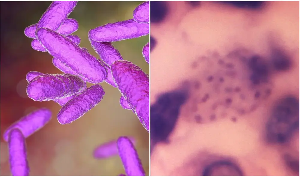 Esta infección, también llamada granuloma inguinal, es causada por la bacteria ‘klebsiella granulomatis’. Foto: composición Esta infección, también llamada granuloma inguinal, es causada por la bacteria ‘klebsiella granulomatis’. Foto: composición
