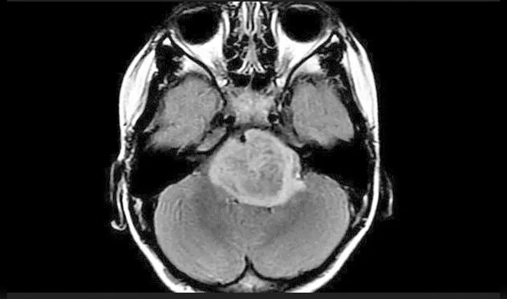 El glioma pontino intrínseco difuso es una enfermedad agresiva e incurable que afecta a niños. Foto: NINDS