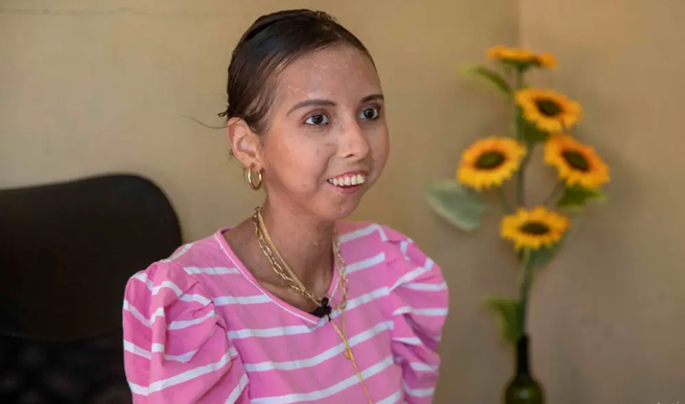 Nathaly Cerda fue diagnosticada con esclerodermia sistémica hace 13 años. Foto: EFE