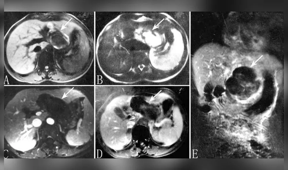 La resonancia magnética reveló el embarazo ectópico hepático. Foto: NCBI La resonancia magnética reveló el embarazo ectópico hepático. Foto: NCBI